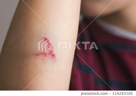 Close-Up of a Child's Arm with a Scratch. Close-Up of a Child's Arm with a Scratch. 114283105