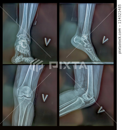 Collage of x-rays of the knee and ankle. Surgical medical technology concept 114321485