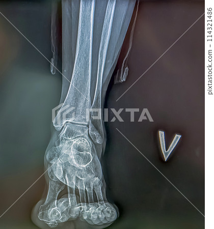 An x-ray shows the skeleton of the ankle on film. Surgical medical technology concept 114321486