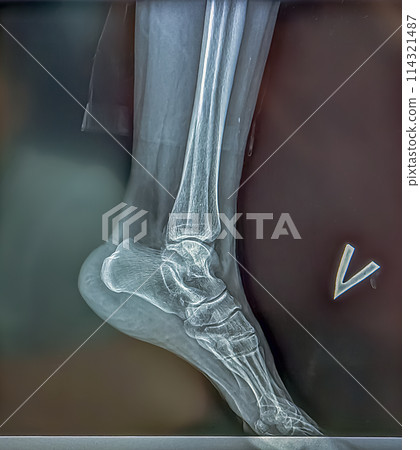 An x-ray shows the skeleton of the ankle on film. Surgical medical technology concept An x-ray shows the skeleton of the ankle on film. Surgical medical technology concept 114321487