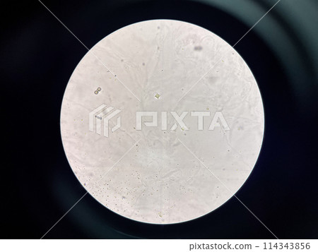 calcium oxalate crystal in urine. calcium oxalate crystal in urine. 114343856