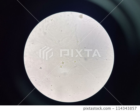 calcium oxalate crystal in urine. calcium oxalate crystal in urine. 114343857