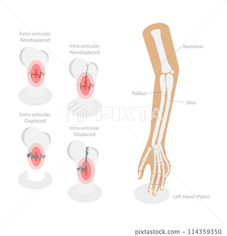 3D Isometric Flat Conceptual Illustration of Distal Radius Fracture, Labeled Educational Diagram 3D Isometric Flat Conceptual Illustration of Distal Radius Fracture, Labeled Educational Diagram 114359350
