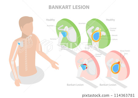 3D Isometric Flat Conceptual Illustration of Bankart Lesion, Educational Diagram 3D Isometric Flat Conceptual Illustration of Bankart Lesion, Educational Diagram 114363781
