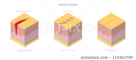 3D Isometric Flat  Conceptual Illustration of Wound Closure, Tissue Injury Healing 114363794