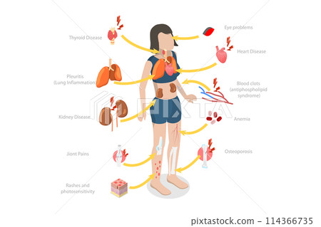 3D Isometric Flat Conceptual Illustration of Lupus Erythematosus, SLE Symptoms and Signs 3D Isometric Flat Conceptual Illustration of Lupus Erythematosus, SLE Symptoms and Signs 114366735