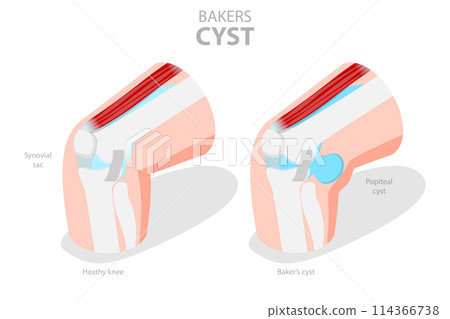 3D Isometric Flat  Conceptual Illustration of Bakers CYST, Traumatology and Prthopedics 114366738