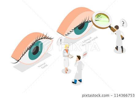 3D Isometric Flat Conceptual Illustration of PTOSIS, Srooping of the Upper Eyelid 3D Isometric Flat Conceptual Illustration of PTOSIS, Srooping of the Upper Eyelid 114366753