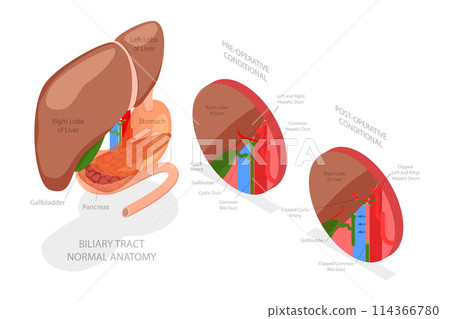 3D Isometric Flat  Conceptual Illustration of Gallbladder Removal Surgery, Cholecystectomy 114366780