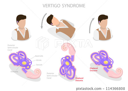 3D Isometric Flat Conceptual Illustration of Vertigo Syndrome , BPPV 3D Isometric Flat Conceptual Illustration of Vertigo Syndrome , BPPV 114366808