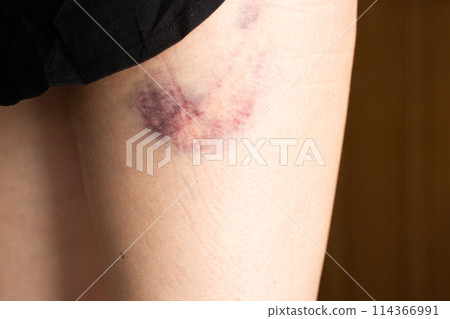 Large bruise at the base of the thigh - bruise on a woman's leg 114366991