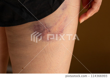 Large bruise at the base of the thigh - bruise on a woman's leg Large bruise at the base of the thigh - bruise on a woman's leg 114366993