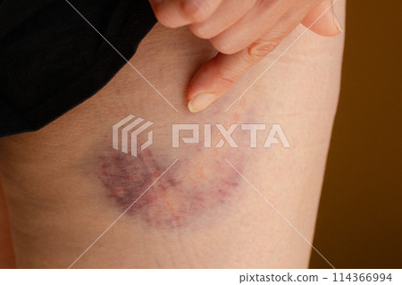 大腿根部大塊瘀傷-女性腿上的瘀傷 114366994