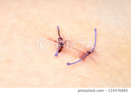 Medical suture with threads on the human body close-up Medical suture with threads on the human body close-up 114376985