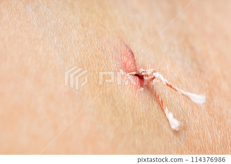 Medical suture with threads on the human body close-up 114376986