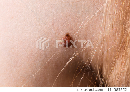 Closeup brown mole on caucasian woman skin. 114385852