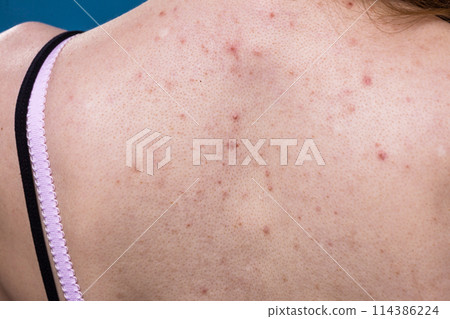 woman with skin problem acne on back woman with skin problem acne on back 114386224