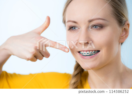 Woman showing her teeth with braces 114386252