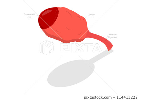 3D Isometric Flat Conceptual Illustration of Endometrioma, Ovarian Cyst 3D Isometric Flat Conceptual Illustration of Endometrioma, Ovarian Cyst 114413222