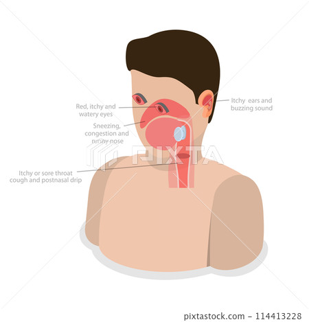 3D Isometric Flat Conceptual Illustration of Allergic Rhinitis, Labeled Educational Diagram 3D Isometric Flat Conceptual Illustration of Allergic Rhinitis, Labeled Educational Diagram 114413228