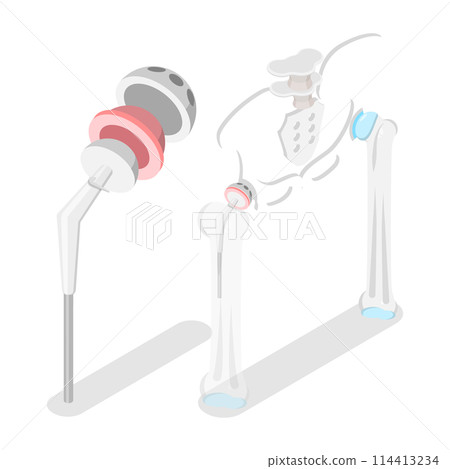 3D Isometric Flat  Conceptual Illustration of Total Hip Replacement, Joint Implant 114413234