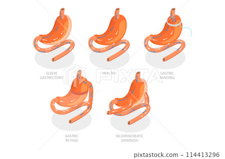 3D Isometric Flat  Conceptual Illustration of Types Of Bariatric Surgery, Sleeve Gastrectomy 114413296