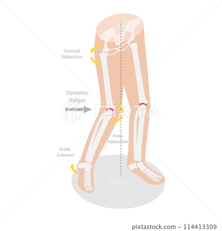 3D Isometric Flat  Conceptual Illustration of Mechanism Of Acl Injury, Labeled Educational Diagram 114413309