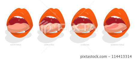 3D Isometric Flat Conceptual Illustration of Sore Or White Tongue, Definition of the Disease by Tongue 3D Isometric Flat Conceptual Illustration of Sore Or White Tongue, Definition of the Disease by Tongue 114413314