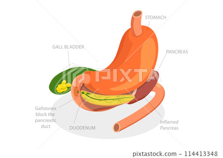 3D Isometric Flat Conceptual Illustration of Acute Pancreatitis, Digestive System Issues 3D Isometric Flat Conceptual Illustration of Acute Pancreatitis, Digestive System Issues 114413348