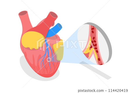 3D Isometric Flat  Conceptual Illustration of Myocardial Infarction, Heart Attack 114420419