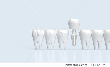 The dental implants for health and medical concept 3d rendering. 114421940