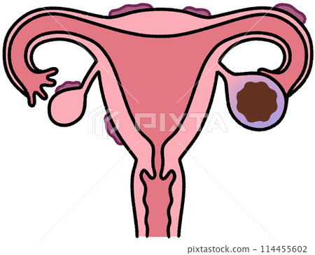 子宮內膜異位症 子宮內膜異位症 114455602