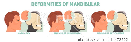 Deformities of mandibular with normal jaw, prognathism and petrognathia Deformities of mandibular with normal jaw, prognathism and petrognathia 114472502