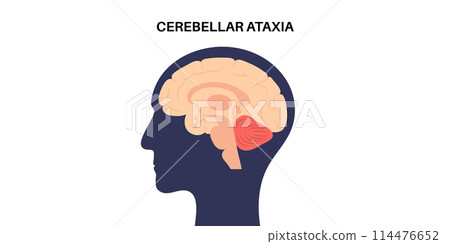 Ataxia cerebellar disorder Ataxia cerebellar disorder 114476652