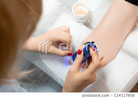 Podologist installs a titanium thread on the big toe using UV lamp for correction of ingrown toenail for woman Podologist installs a titanium thread on the big toe using UV lamp for correction of ingrown toenail for woman 114517608
