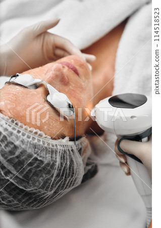 A woman receives IPL therapy in a beauty salon. A woman receives IPL therapy in a beauty salon. 114518523