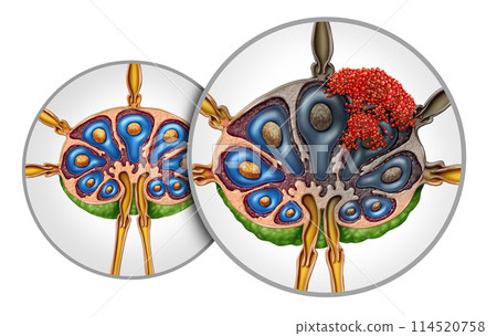 Lymphoma Lymph Node Cancer 114520758