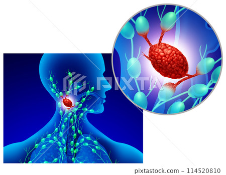 Swollen Lymph Node 114520810