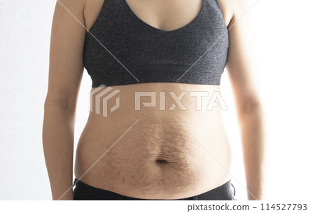 產後女性腹部有妊娠紋的特寫 產後女性腹部有妊娠紋的特寫 114527793