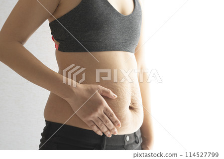 Close-up of a woman's stomach with postpartum stretch marks Close-up of a woman's stomach with postpartum stretch marks 114527799