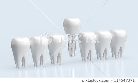 The dental implants for health and medical concept 3d rendering. 114547371