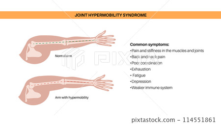 Joint hypermobility poster 114551861