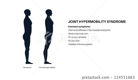 Joint hypermobility poster 114551863