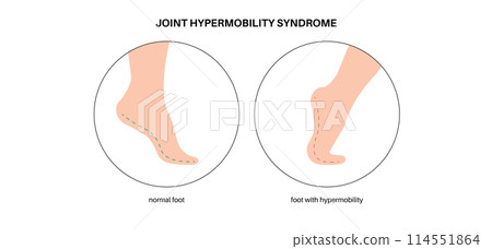 Joint hypermobility poster 114551864