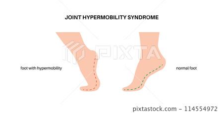 Joint hypermobility poster 114554972