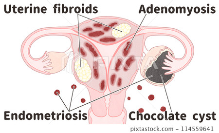 子宮肌瘤、子宮肌腺症、子宮內膜異位症的併發症 簡單易懂的英文圖解 114559641