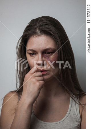 Domestic violence, abuse woman with bruise on face 114572842