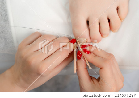 Podologist installs a titanium thread on the big toe for correction of ingrown toenail. Professional pedicure concept. 114577287