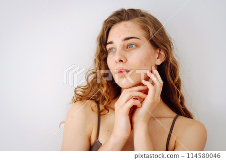 Close-up portrait of a beautiful woman without makeup with imperfect skin. Acne skin. Natural beauty Close-up portrait of a beautiful woman without makeup with imperfect skin. Acne skin. Natural beauty 114580046