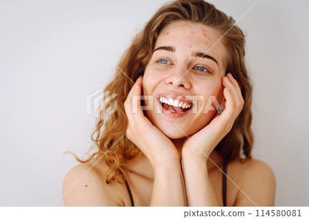 Close-up portrait of a beautiful woman without makeup with imperfect skin. Acne skin. Natural beauty Close-up portrait of a beautiful woman without makeup with imperfect skin. Acne skin. Natural beauty 114580081